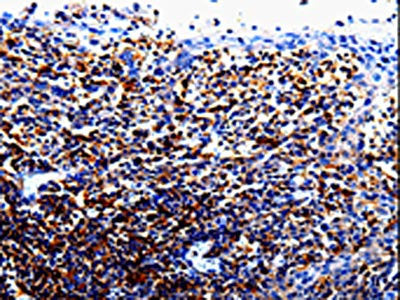 The image on the left is immunohistochemistry of paraffin-embedded Human tosil tissue using CSB-PA153938(IL10RA Antibody) at dilution 1/60, on the right is treated with fusion protein. (Original magnification: ×200)