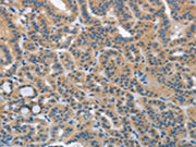 The image on the left is immunohistochemistry of paraffin-embedded Human thyroid cancer tissue using CSB-PA153980(HSD3B1 Antibody) at dilution 1/40, on the right is treated with fusion protein. (Original magnification: ×200)