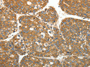 The image on the left is immunohistochemistry of paraffin-embedded Human liver cancer tissue using CSB-PA153990(RPLP0 Antibody) at dilution 1/40, on the right is treated with fusion protein. (Original magnification: ×200)