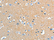 The image on the left is immunohistochemistry of paraffin-embedded Human brain tissue using CSB-PA154092(ADD2 Antibody) at dilution 1/20, on the right is treated with fusion protein. (Original magnification: ×200)