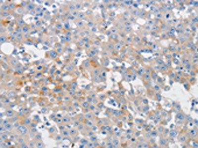 The image on the left is immunohistochemistry of paraffin-embedded Human breast cancer tissue using CSB-PA154128(MUC5AC Antibody) at dilution 1/80, on the right is treated with synthetic peptide. (Original magnification: ×200)