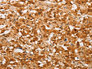 The image on the left is immunohistochemistry of paraffin-embedded Human thyroid cancer tissue using CSB-PA154285(THOC7 Antibody) at dilution 1/30, on the right is treated with fusion protein. (Original magnification: ×200)