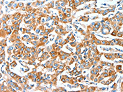The image on the left is immunohistochemistry of paraffin-embedded Human breast cancer tissue using CSB-PA154373(AFAP1 Antibody) at dilution 1/20, on the right is treated with fusion protein. (Original magnification: X200)