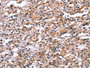 The image on the left is immunohistochemistry of paraffin-embedded Human thyroid cancer tissue using CSB-PA154414(TUBGCP2 Antibody) at dilution 1/15, on the right is treated with synthetic peptide. (Original magnification: ×200)