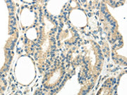 The image on the left is immunohistochemistry of paraffin-embedded Human thyroid cancer tissue using CSB-PA154465(WNT6 Antibody) at dilution 1/35, on the right is treated with synthetic peptide. (Original magnification: ×200)