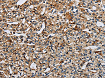 The image on the left is immunohistochemistry of paraffin-embedded Human prostate cancer tissue using CSB-PA154507(EIF2AK3 Antibody) at dilution 1/50, on the right is treated with synthetic peptide. (Original magnification: ×200)