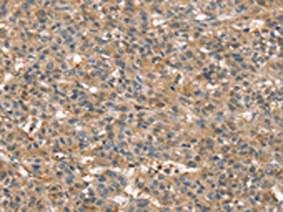The image on the left is immunohistochemistry of paraffin-embedded Human liver cancer tissue using CSB-PA154755(SSX2IP Antibody) at dilution 1/45, on the right is treated with fusion protein. (Original magnification: ×200)