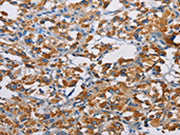 The image on the left is immunohistochemistry of paraffin-embedded Human thyroid cancer tissue using CSB-PA155145(TSPEAR Antibody) at dilution 1/50, on the right is treated with fusion protein. (Original magnification: ×200)