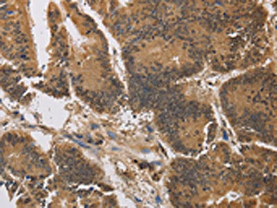 The image on the left is immunohistochemistry of paraffin-embedded Human colon cancer tissue using CSB-PA155172(KCNG4 Antibody) at dilution 1/40, on the right is treated with synthetic peptide. (Original magnification: ×200)