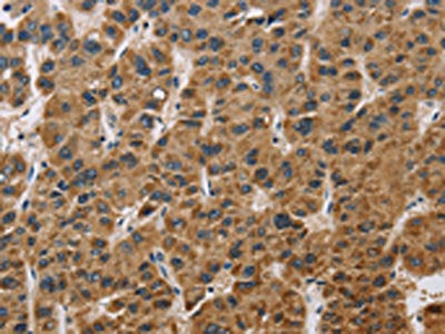 The image on the left is immunohistochemistry of paraffin-embedded Human liver cancer tissue using CSB-PA155390(IL19 Antibody) at dilution 1/40, on the right is treated with synthetic peptide. (Original magnification: ×200)
