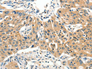 The image on the left is immunohistochemistry of paraffin-embedded Human lung cancer tissue using CSB-PA155558(SLC11A2 Antibody) at dilution 1/65, on the right is treated with synthetic peptide. (Original magnification: ×200)