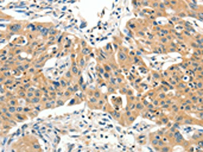 The image on the left is immunohistochemistry of paraffin-embedded Human lung cancer tissue using CSB-PA155558(SLC11A2 Antibody) at dilution 1/65, on the right is treated with synthetic peptide. (Original magnification: ×200)