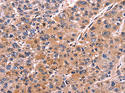 The image on the left is immunohistochemistry of paraffin-embedded Human liver cancer tissue using CSB-PA155590(COL20A1 Antibody) at dilution 1/30, on the right is treated with fusion protein. (Original magnification: ×200)