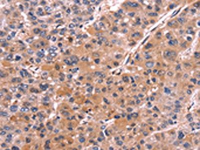 The image on the left is immunohistochemistry of paraffin-embedded Human liver cancer tissue using CSB-PA155590(COL20A1 Antibody) at dilution 1/30, on the right is treated with fusion protein. (Original magnification: ×200)