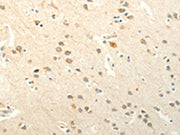 The image on the left is immunohistochemistry of paraffin-embedded Human brain tissue using CSB-PA155823(SMO Antibody) at dilution 1/20, on the right is treated with synthetic peptide. (Original magnification: ×200)