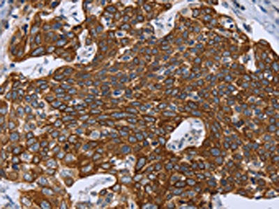 The image on the left is immunohistochemistry of paraffin-embedded Human cervical cancer tissue using CSB-PA156499(GRPR Antibody) at dilution 1/40, on the right is treated with synthetic peptide. (Original magnification: ×200)