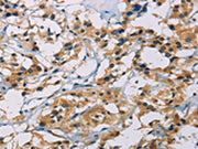 The image on the left is immunohistochemistry of paraffin-embedded Human thyroid cancer tissue using CSB-PA156748(CSNK1E Antibody) at dilution 1/30, on the right is treated with fusion protein. (Original magnification: ×200)