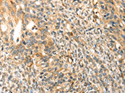 The image on the left is immunohistochemistry of paraffin-embedded Human breast cancer tissue using CSB-PA156794(TRPV3 Antibody) at dilution 1/30, on the right is treated with synthetic peptide. (Original magnification: ×200)