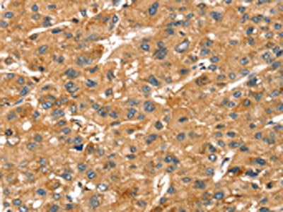 The image on the left is immunohistochemistry of paraffin-embedded Human liver cancer tissue using CSB-PA156898(SPTAN1 Antibody) at dilution 1/40, on the right is treated with synthetic peptide. (Original magnification: ×200)