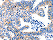The image on the left is immunohistochemistry of paraffin-embedded Human colon cancer tissue using CSB-PA156966(LRPAP1 Antibody) at dilution 1/100, on the right is treated with synthetic peptide. (Original magnification: ×200)