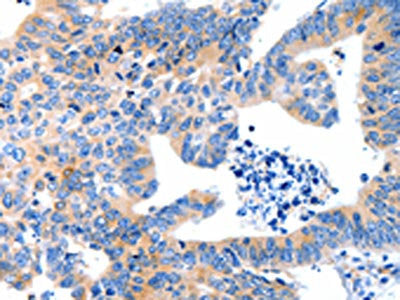 The image on the left is immunohistochemistry of paraffin-embedded Human colon cancer tissue using CSB-PA156966(LRPAP1 Antibody) at dilution 1/100, on the right is treated with synthetic peptide. (Original magnification: ×200)
