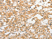The image on the left is immunohistochemistry of paraffin-embedded Human thyroid cancer tissue using CSB-PA157170(TLR3 Antibody) at dilution 1/40, on the right is treated with fusion protein. (Original magnification: ×200)
