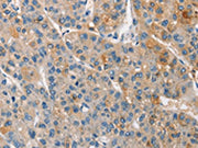 The image on the left is immunohistochemistry of paraffin-embedded Human liver cancer tissue using CSB-PA157353(APOA5 Antibody) at dilution 1/15, on the right is treated with synthetic peptide. (Original magnification: ×200)