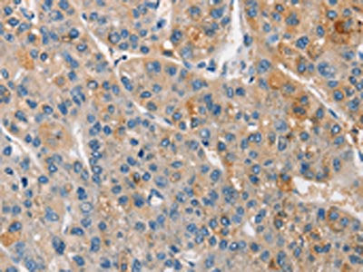 The image on the left is immunohistochemistry of paraffin-embedded Human liver cancer tissue using CSB-PA157353(APOA5 Antibody) at dilution 1/15, on the right is treated with synthetic peptide. (Original magnification: ×200)