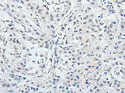 The image on the left is immunohistochemistry of paraffin-embedded Human ovarian cancer tissue using CSB-PA157435(RUNX3 Antibody) at dilution 1/25, on the right is treated with synthetic peptide. (Original magnification: ×200)