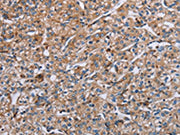 The image on the left is immunohistochemistry of paraffin-embedded Human prostate cancer tissue using CSB-PA157482(PLG Antibody) at dilution 1/40, on the right is treated with synthetic peptide. (Original magnification: ×200)