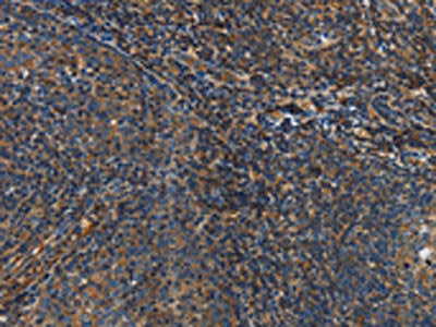 The image on the left is immunohistochemistry of paraffin-embedded Human tonsil tissue using CSB-PA157805(IL17D Antibody) at dilution 1/50, on the right is treated with synthetic peptide. (Original magnification: ×200)