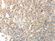 The image on the left is immunohistochemistry of paraffin-embedded Human ovarian cancer tissue using CSB-PA157934(PTHLH Antibody) at dilution 1/20, on the right is treated with fusion protein. (Original magnification: ×200)