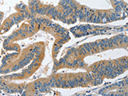 The image on the left is immunohistochemistry of paraffin-embedded Human colon cancer tissue using CSB-PA158009(PIK3R4 Antibody) at dilution 1/25, on the right is treated with synthetic peptide. (Original magnification: ×200)