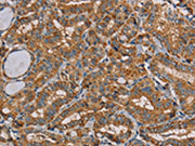 The image on the left is immunohistochemistry of paraffin-embedded Human thyroid cancer tissue using CSB-PA158054(MRPL11 Antibody) at dilution 1/20, on the right is treated with fusion protein. (Original magnification: ×200)