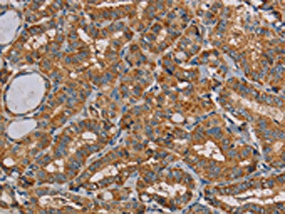 The image on the left is immunohistochemistry of paraffin-embedded Human thyroid cancer tissue using CSB-PA158054(MRPL11 Antibody) at dilution 1/20, on the right is treated with fusion protein. (Original magnification: ×200)