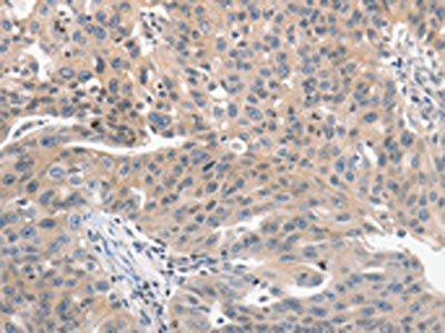 The image on the left is immunohistochemistry of paraffin-embedded Human ovarian cancer tissue using CSB-PA158058(PRKD1 Antibody) at dilution 1/70, on the right is treated with synthetic peptide. (Original magnification: ×200)
