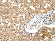 The image on the left is immunohistochemistry of paraffin-embedded Human ovarian cancer tissue using CSB-PA158224(PAK7 Antibody) at dilution 1/10, on the right is treated with fusion protein. (Original magnification: ×200)