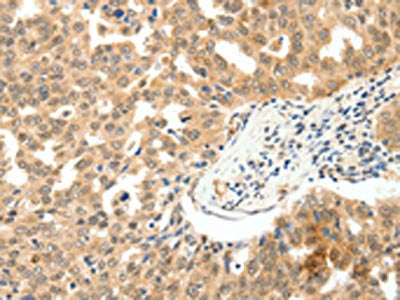 The image on the left is immunohistochemistry of paraffin-embedded Human ovarian cancer tissue using CSB-PA158224(PAK7 Antibody) at dilution 1/10, on the right is treated with fusion protein. (Original magnification: ×200)
