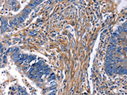 The image on the left is immunohistochemistry of paraffin-embedded Human rectal cancer tissue using CSB-PA158258(CXCR5 Antibody) at dilution 1/25, on the right is treated with synthetic peptide. (Original magnification: ×200)