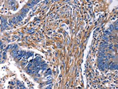 The image on the left is immunohistochemistry of paraffin-embedded Human rectal cancer tissue using CSB-PA158258(CXCR5 Antibody) at dilution 1/25, on the right is treated with synthetic peptide. (Original magnification: ×200)