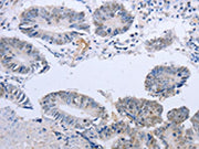 The image on the left is immunohistochemistry of paraffin-embedded Human colon cancer tissue using CSB-PA158538(DOK5 Antibody) at dilution 1/20, on the right is treated with fusion protein. (Original magnification: ×200)