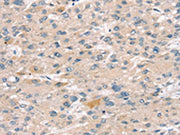 The image on the left is immunohistochemistry of paraffin-embedded Human liver cancer tissue using CSB-PA158594(SULT2B1 Antibody) at dilution 1/25, on the right is treated with fusion protein. (Original magnification: ×200)