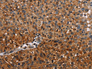 The image on the left is immunohistochemistry of paraffin-embedded Human breast cancer tissue using CSB-PA158660(NMT2 Antibody) at dilution 1/20, on the right is treated with fusion protein. (Original magnification: ×200)