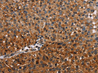 The image on the left is immunohistochemistry of paraffin-embedded Human breast cancer tissue using CSB-PA158660(NMT2 Antibody) at dilution 1/20, on the right is treated with fusion protein. (Original magnification: ×200)