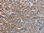 The image on the left is immunohistochemistry of paraffin-embedded Human prostate cancer tissue using CSB-PA158811(PLXND1 Antibody) at dilution 1/40, on the right is treated with synthetic peptide. (Original magnification: ×200)