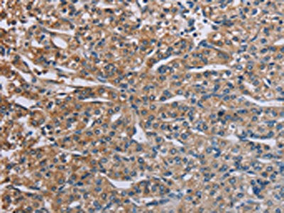 The image on the left is immunohistochemistry of paraffin-embedded Human prostate cancer tissue using CSB-PA158811(PLXND1 Antibody) at dilution 1/40, on the right is treated with synthetic peptide. (Original magnification: ×200)