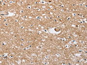 The image on the left is immunohistochemistry of paraffin-embedded Human brain tissue using CSB-PA158942(SOCS2 Antibody) at dilution 1/40, on the right is treated with fusion protein. (Original magnification: ×200)