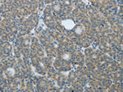 The image on the left is immunohistochemistry of paraffin-embedded Human thyroid cancer tissue using CSB-PA158988(TP63 Antibody) at dilution 1/20, on the right is treated with fusion protein. (Original magnification: ×200)