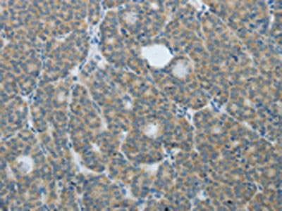 The image on the left is immunohistochemistry of paraffin-embedded Human thyroid cancer tissue using CSB-PA158988(TP63 Antibody) at dilution 1/20, on the right is treated with fusion protein. (Original magnification: ×200)