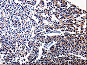 The image on the left is immunohistochemistry of paraffin-embedded Human tonsil tissue using CSB-PA159155(BIRC5 Antibody) at dilution 1/15, on the right is treated with fusion protein. (Original magnification: ×200)